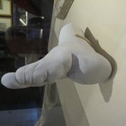 Plâtre montrant la déformation d'un pied après bandage et cassure